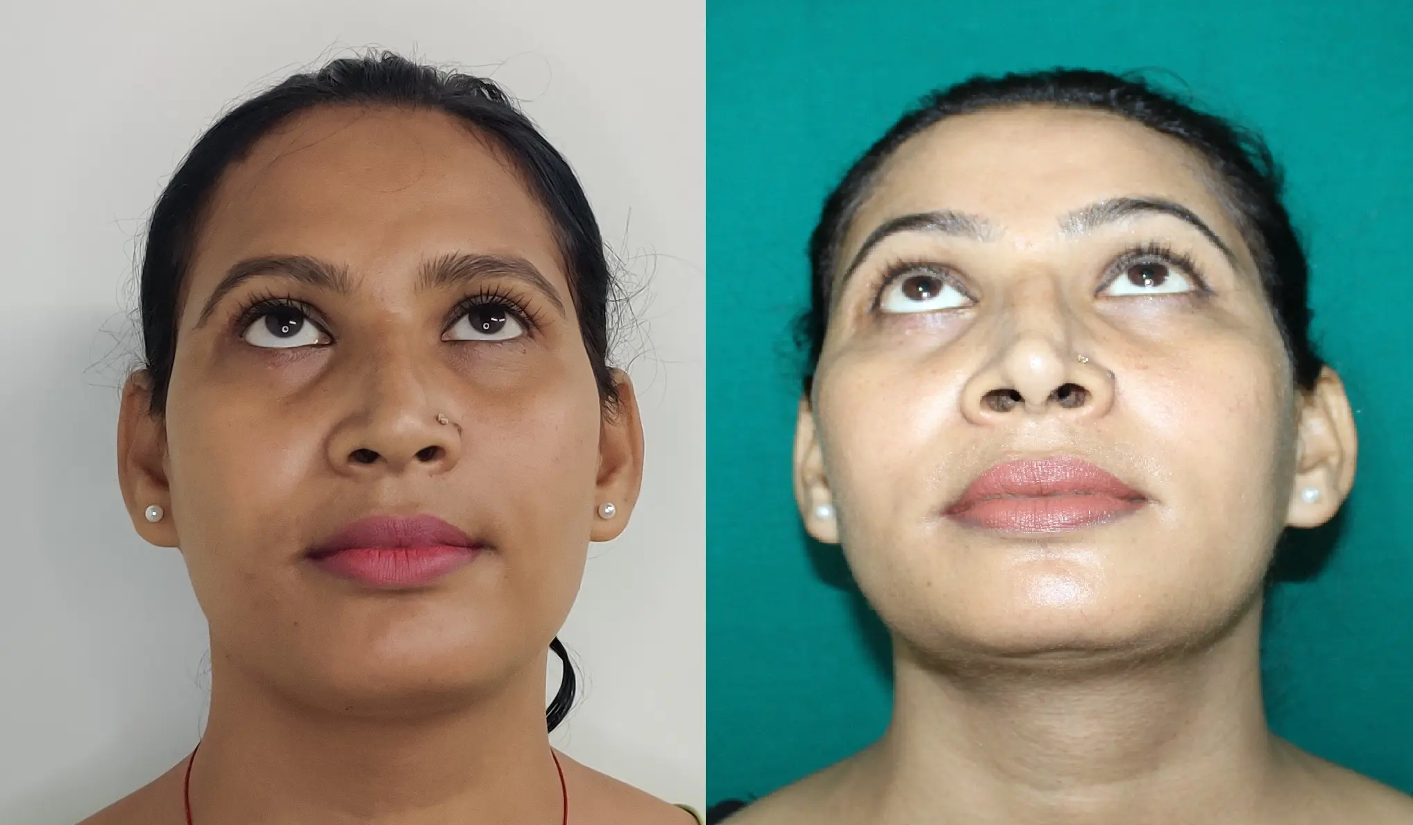 Clinical Comparison of Forehead Structural Reconstruction